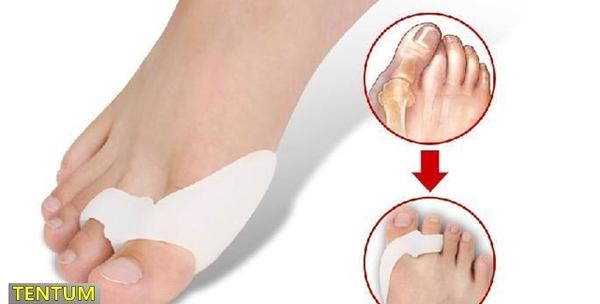 2 anatomska silikonska štitnika za deformirane nožne palčeve – Hallux Valgus (čukalj) za 59kn!